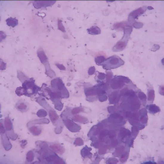 Bronchial Lavage for AFB Stain